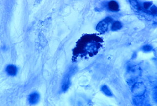 Acid-Fast Bacteria Discovered in Prostate Cancer
